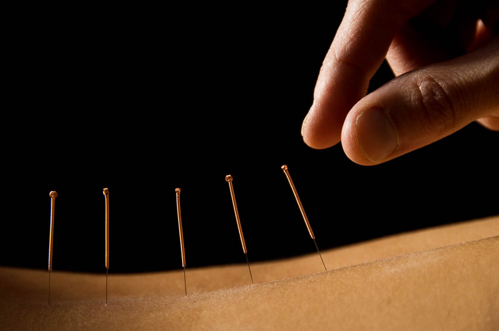 Combinations Of Special Acupuncture Treatments for Spinal-Related Diseases & Emotional Disorders