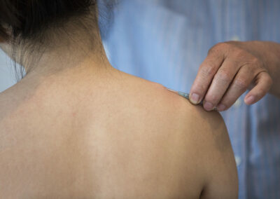 Fu’s Subcutaneous Needling